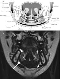 cavity and oropharynx radiology key