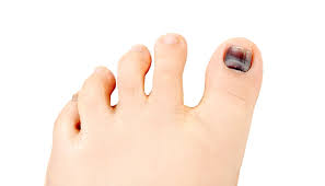 what causes a black toenail should you