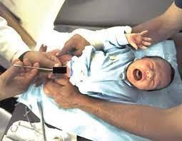When the circumcision has taken place, the affected area will be covered with gauze to prevent excessive bleeding, and this should be kept on for 24 hours to support the healing process. Newborn Circumcision Caring For Your Child After The Procedure Tribune Online