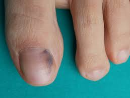 difference between toenail hematoma and