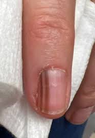 update on nail unit histopathology