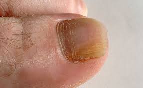 how to prevent nail fungus and treat