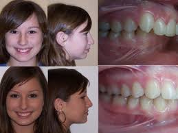 Check spelling or type a new query. Getting An Orthodontic Expander To Fix Your Child S Bite