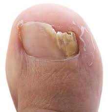 what is toenail fungus causes