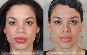 Check spelling or type a new query. Rhinoplasty Before After Photos At Beverly Hills Profiles