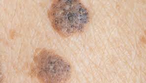 Of course, your specialist is the main person whose advice you should follow but it doesn't do anyone harm. Seborrheic Keratosis Vs Melanoma What S The Difference