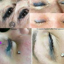 saline removal and migrated eyeliners