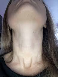 thyroid swelling on one side or