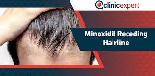 minoxidil receding hairline clinicexpert