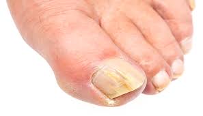 when to get treatment for nail fungus