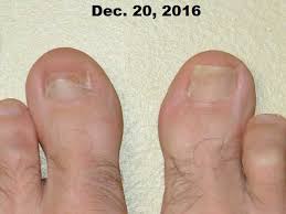 dhaa serum applied to toenail fungus