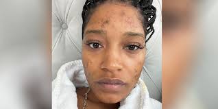 keke palmer talks about pcos acne in