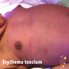 erythema toxi skin deep