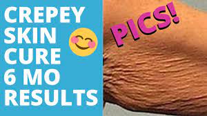how to fix crepey skin naturally you
