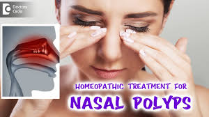 nasal polyps best homeopathic