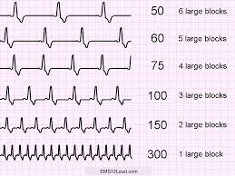 Large Block Method For Heart Rate Calculation Ems 12 Lead