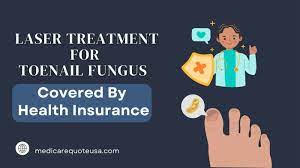 health insurance cover laser treatment