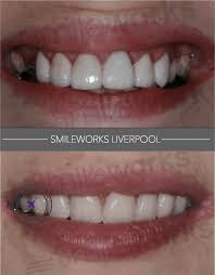 Free dental implants for low income uk. Dental Implants Liverpool 94 M Cost Replace Missing Teeth In 2020