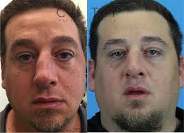 This may cause congestion, problems with breathing, or nasal discharge. Nyc Deviated Septum Surgery New York Septoplasty Repair Ues