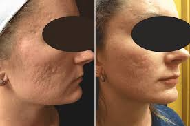 deep acne scars with rf microneedling