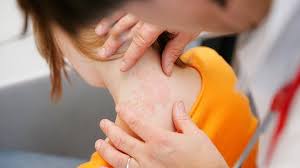 what is dyshidrotic eczema symptoms