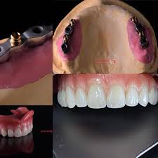 cazuri clinice implant dentar proteza