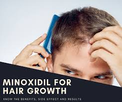 minoxidil for hair growth know the