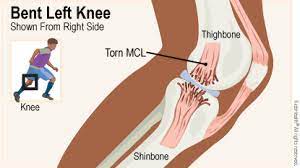 Minor pain with some tenderness inside the knee. Medial Collateral Ligament Mcl Injuries For Teens Nemours Kidshealth