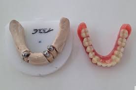 Original medicare does not offer coverage for dentures, but medicare advantage plans may help with some costs. Prothetischer Totalschaden Technik Ztm Aktuell De