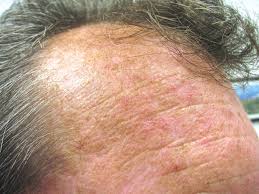 actinic keratosis treatments with a