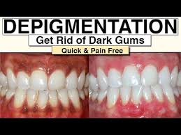 black gums how to get rid of them with