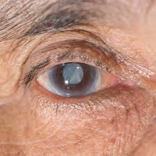 recover after cataract surgery