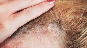 scalp psoriasis causes and treatment