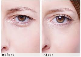 eyelid lifting or using lid up strips