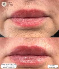 can you get lip fillers while pregnant