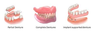 How long does it take to make dentures after teeth have been extracted? Dentures Guide On Dental Dentures Prices Procedure Reviews