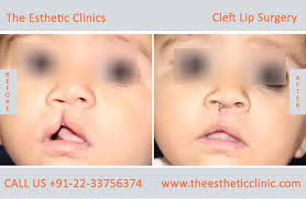 cleft lip surgery in india best cleft