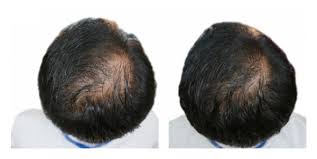 The egg yolk is useful as it is a good source of amino acids and proteins. Effect Of Pumpkin Seed Oil On Hair Growth In Men With Androgenetic Alopecia A Randomized Double Blind Placebo Controlled Trial