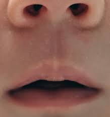 what is this line in middle of philtrum