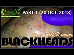 And the 2018 oscar for best picture goes to. Blackhead Removal Part 1 20 10 2018 By Dr Lalit Kasana Youtube
