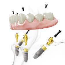4 dental implants cost hyderabad