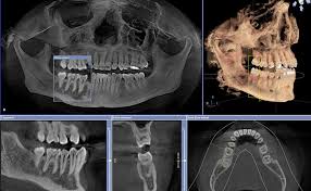 cone beam ct scanner dental implants