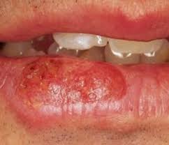 lip cancer pictures causes symptoms