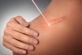 laser scars and stretch marks removal