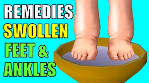 swollen feet and ankles edema