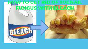 toenail fungus with bleach