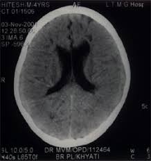 Maybe you would like to learn more about one of these? Periventricular Leucomalacia Pvl As Seen On Ct Caused Due To Hypoxic Ischaemic Encephalopathy Or Pyogenic Meningitis