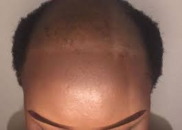 Sur quelles coiffures et coupes miser quand on a les cheveux clairsemés? Les Abus De Tissages Et De Defrisages M Ont Rendue Chauve Bbc News Afrique