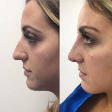 Don't touch or rub the treated area for at least six hours after treatment. Non Surgical Rhinoplasty Nose Filler Dr Medispa Award Winning Clinics