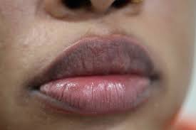 lips rejuventation aesthetic clinic
